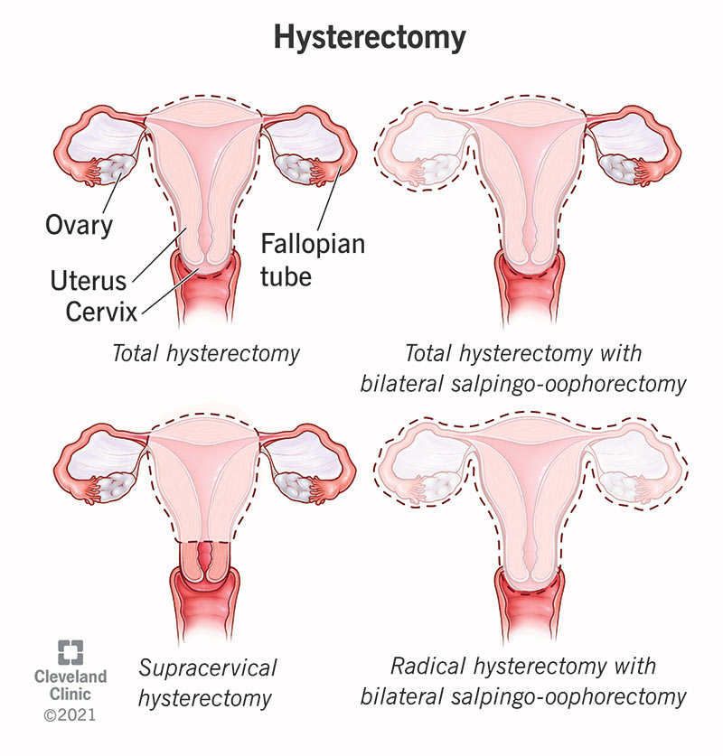 hysterectomy